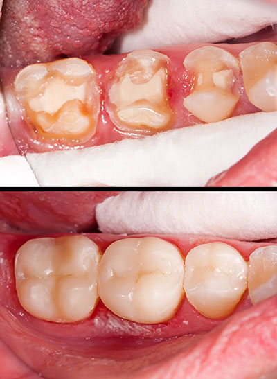 Glowing Smile Dental Studio | Implant Dentistry, Dentures and Root Canals