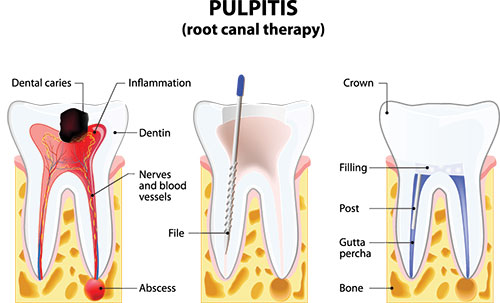 Glowing Smile Dental Studio | Sports Mouthguards, Invisalign reg  and Root Canals