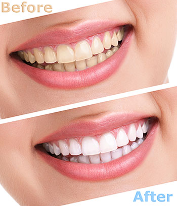 Glowing Smile Dental Studio | Veneers, All-on-6 reg  and Periodontal Treatment